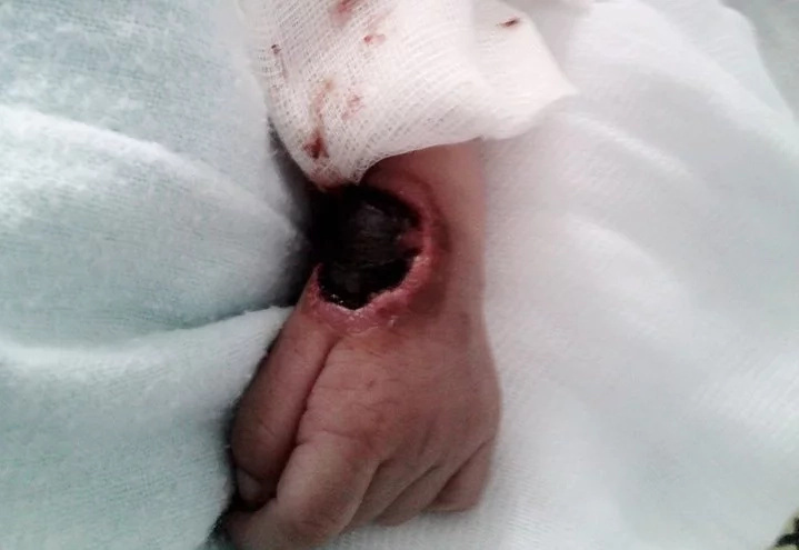 Mother blames doctor for baby's huge wound Mother blames doctor for baby's huge wound