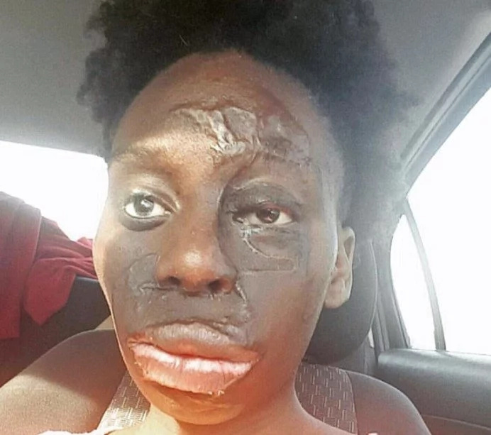 Meet burns survivor, 25, who wears her flaws like diamonds and rejects surgery (photos) Meet burns survivor, 25, who wears her flaws like diamonds and rejects surgery (photos)