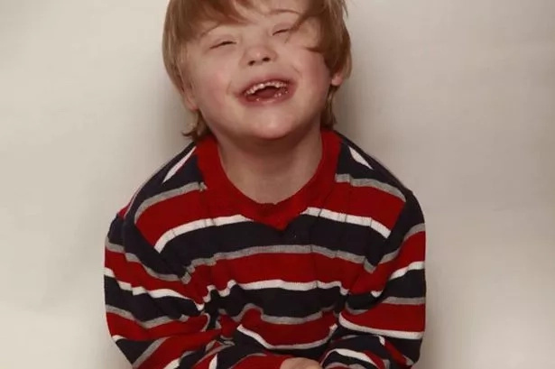 Little boy looks like he burnt in the fire after rare allergy Little boy looks like he burnt in the fire after rare allergy