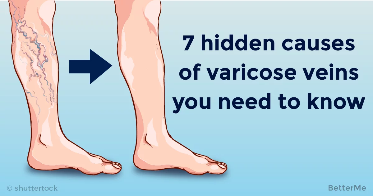 54  Can i workout with varicocele for ABS