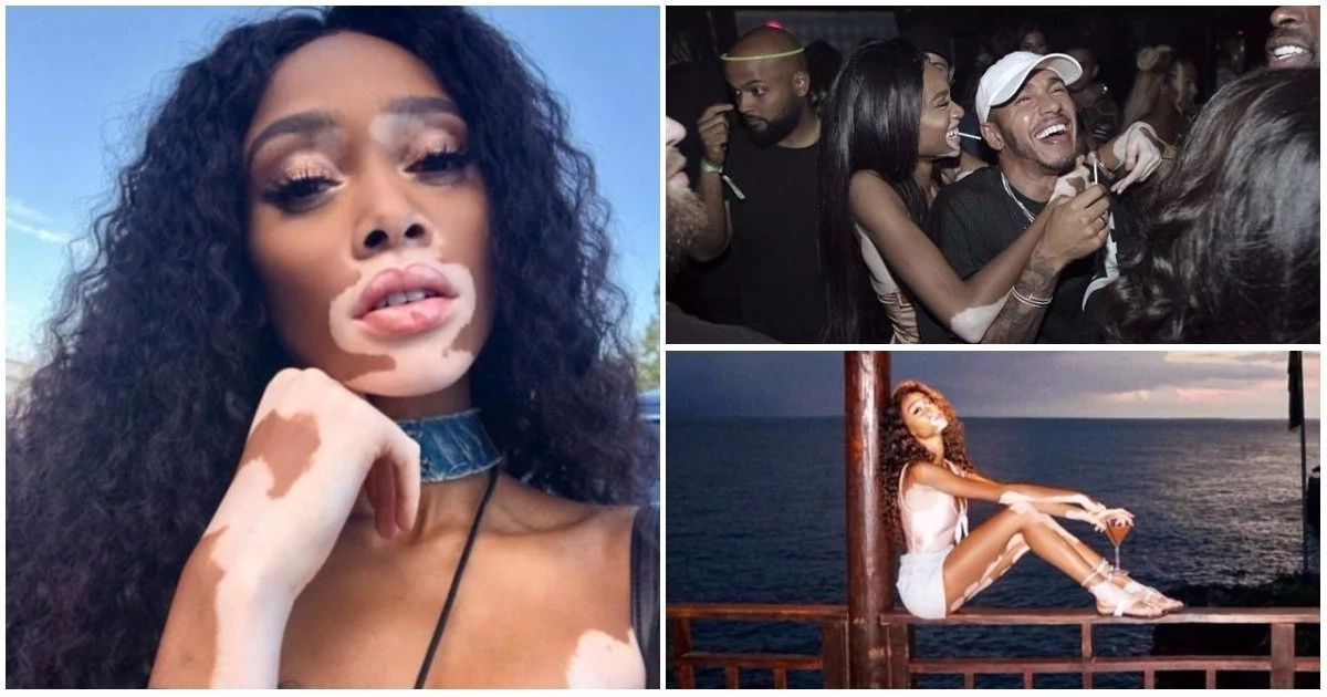 "I'm beautiful because I know it" - Model with vitiligo shares photos of herself to inspire body positivity