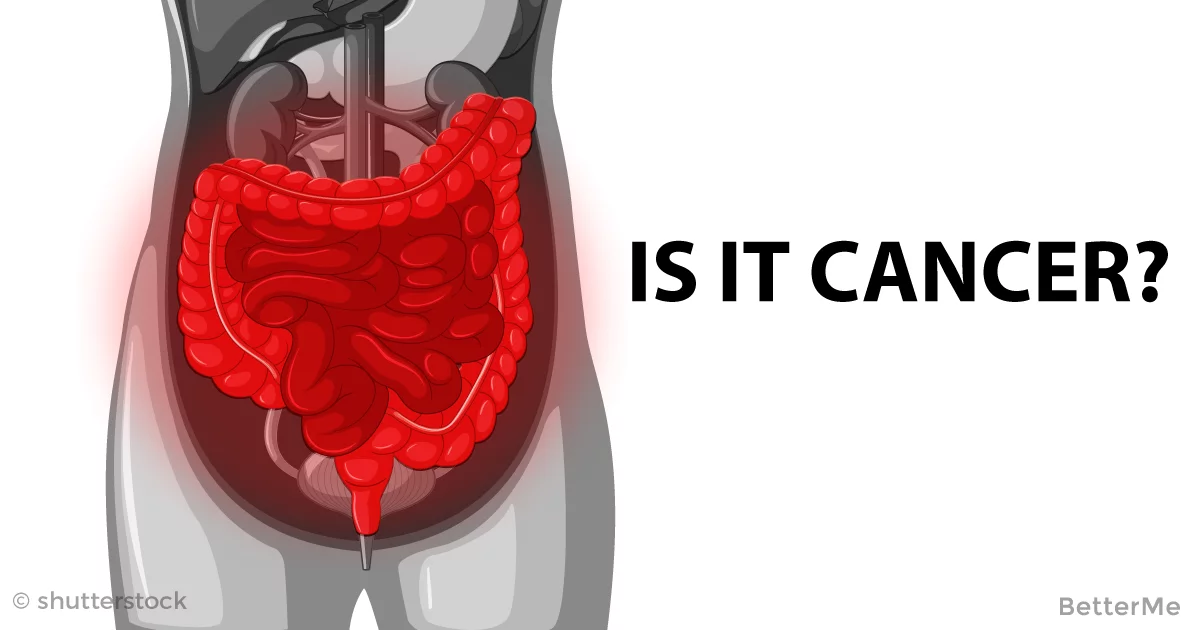 Colon Cancer Symptoms In Women To Check Now