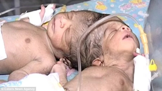 Woman, 35, gives birth to CONJOINED twins fused at head,doctors say they may be sharing brain (photos, video) Woman, 35, gives birth to CONJOINED twins fused at head,doctors say they may be sharing brain (photos, video)