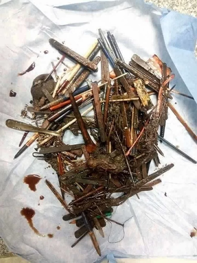 Woman suffers severe abdominal pain. This is what doctors found inside her stomach! Woman suffers severe abdominal pain. This is what doctors found inside her stomach!