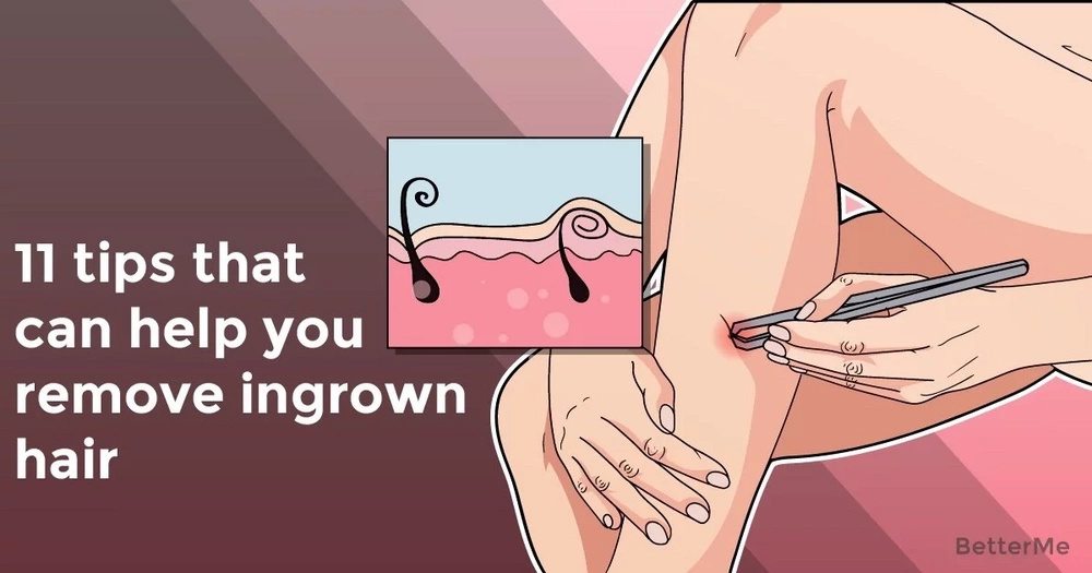11 Tips That Can Help You Remove Ingrown Hair