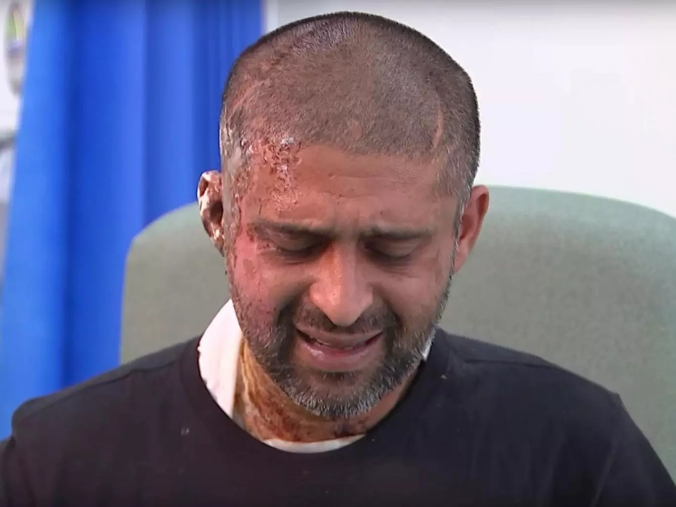 This man and his cousin were hospitalized. The reason was an acid attack from a hateful man! This man and his cousin were hospitalized. The reason was an acid attack from a hateful man!