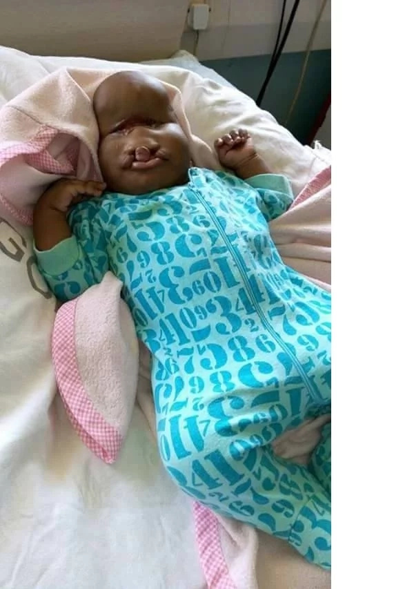 Child born with facial deformity abandoned in a Kisumu hospital (photos)