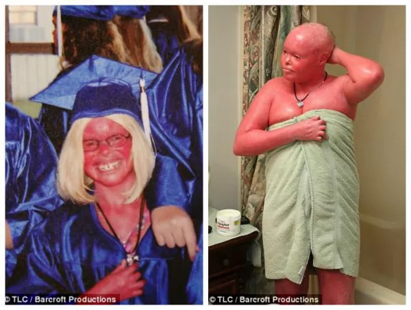 Woman With Harlequin Ichthyosis Becomes Happy Mother Tuko ...