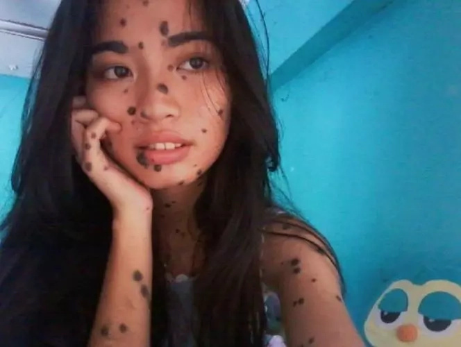 She was bullied because of her moles. She redefines beauty by joining Miss Universe Malaysia She was bullied because of her moles. She redefines beauty by joining Miss Universe Malaysia