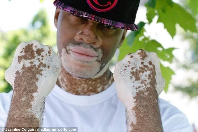 Colgan's project highlights people living with vitiligo. Photo: Jasmin Colgan Colgan's project highlights people living with vitiligo. Photo: Jasmin Colgan