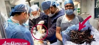 La mujer tuvo un dolor terrible durante 10 días. Los doctores quedaron estupefactos por lo que vieron en su estómago
