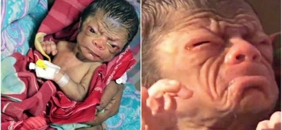 Meet Asian baby who was born looking like a 80-year-old man