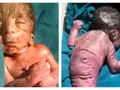 Shocking photos of a baby 'mermaid' who died shortly after birth in India!