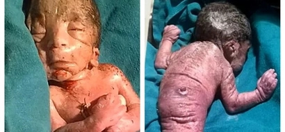 Shocking photos of a baby 'mermaid' who died shortly after birth in India!