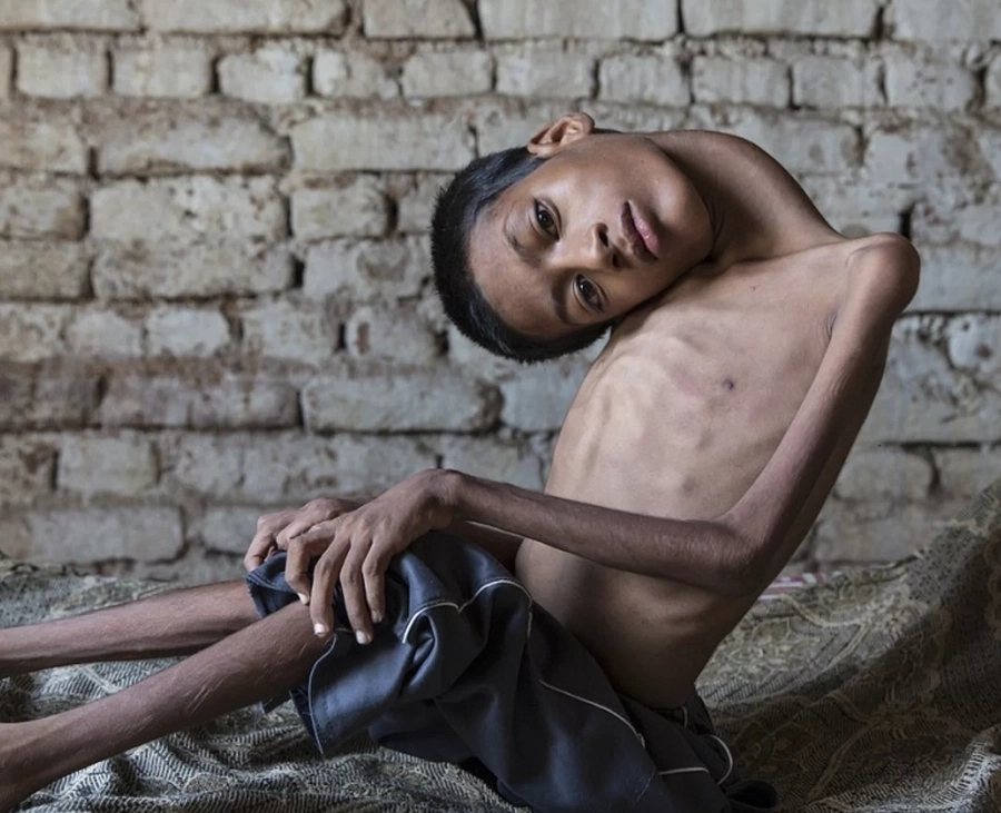 Good Samaritan helps Indian boy with rare disease get surgery Good Samaritan helps Indian boy with rare disease get surgery