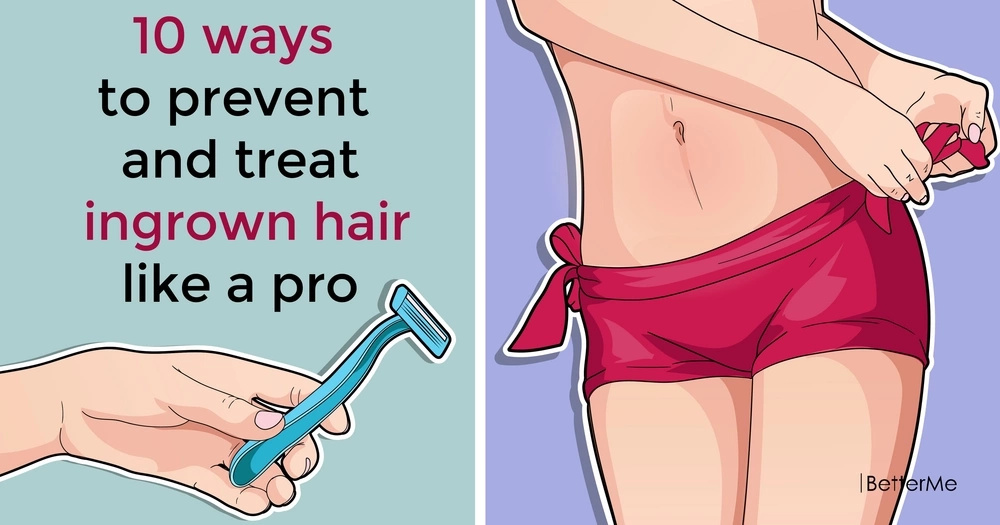 10 Ways To Prevent And Treat Ingrown Hair Like A Pro