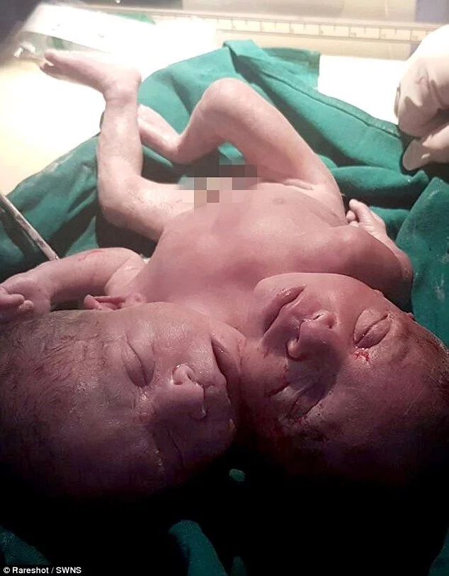 Gift from God! Baby with 2 HEADS dies moments after birth (photos)