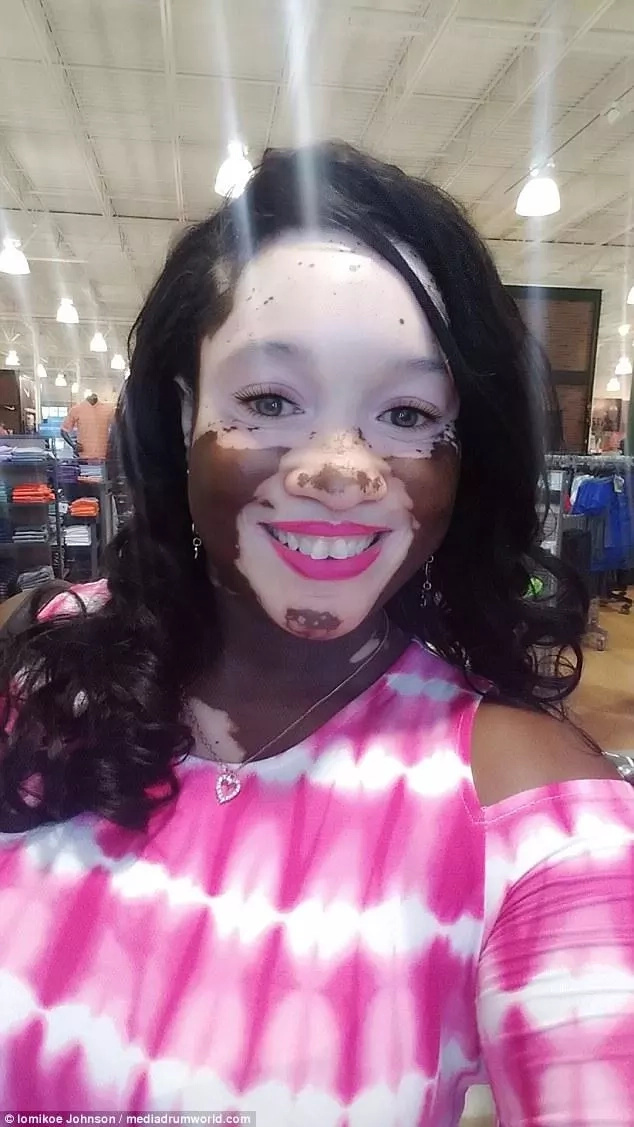 Johnson has vitiligo and is proud of her appearance. Photo: Iomikoe Johnson