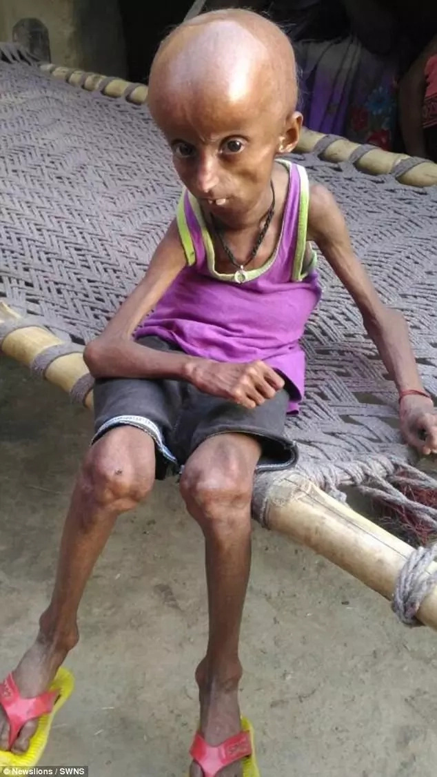 Man, 21, with rare genetic condition has body of 160-year-old pensioner Man, 21, with rare genetic condition has body of 160-year-old pensioner