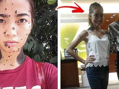 Half-Pinay joins Miss Universe Malaysia, redefines beauty standards in spite of skin condition