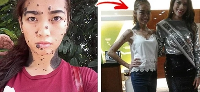 Half-Pinay joins Miss Universe Malaysia, redefines beauty standards in spite of skin condition