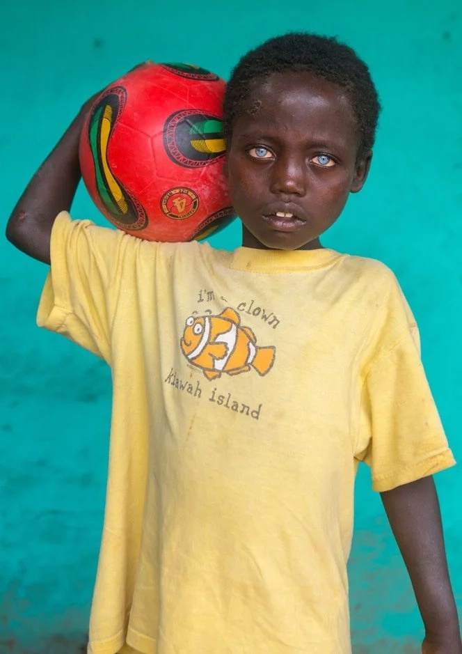 African boy, 8, has rare condition that makes his eyes a mesmerizing BLUE (photos)