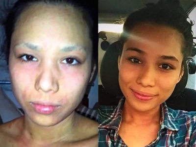 This beauty queen used to have skin problems, but look at her now!