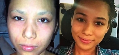 This beauty queen used to have skin problems, but look at her now!