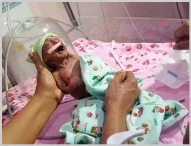 Bebé de dos semanas de nacida fue abandona por sus padres porque nació “fea” con un una debilitante enfermedad