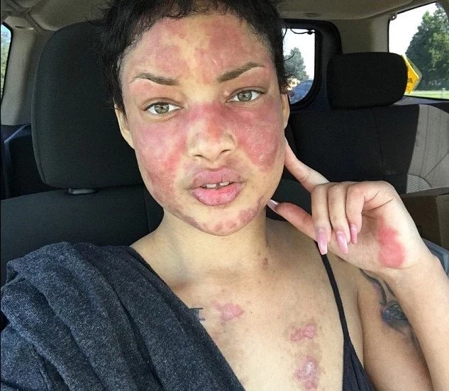 Woman’s Skin Burns From Inside Out Every Time She Goes Outside (Photos)