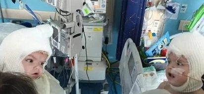 Awww! Conjoined twins look at each other for the first time after separating operation