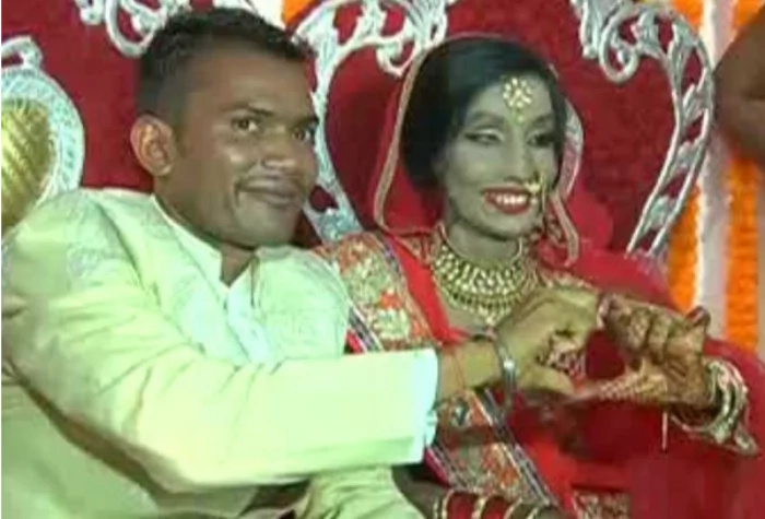 Woman whose face was totally burned in acid attack gets married Woman whose face was totally burned in acid attack gets married