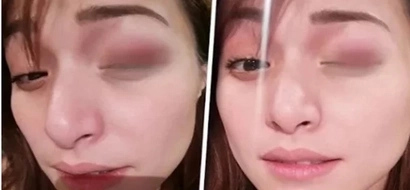 You will be shocked when you find out who kicked Christine Reyes causing an ugly bruise on her left eye