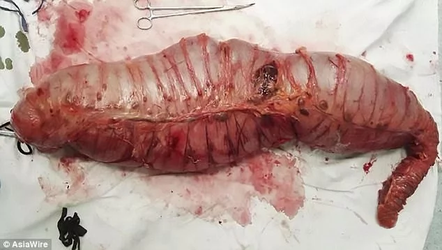 This man was heavily constipated his entire life. Upon surgery, doctors removed 22 years worth of accumulated feces! Ugh! This man was heavily constipated his entire life. Upon surgery, doctors removed 22 years worth of accumulated feces! Ugh!