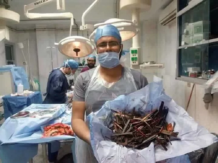 Woman suffers severe abdominal pain. This is what doctors found inside her stomach! Woman suffers severe abdominal pain. This is what doctors found inside her stomach!