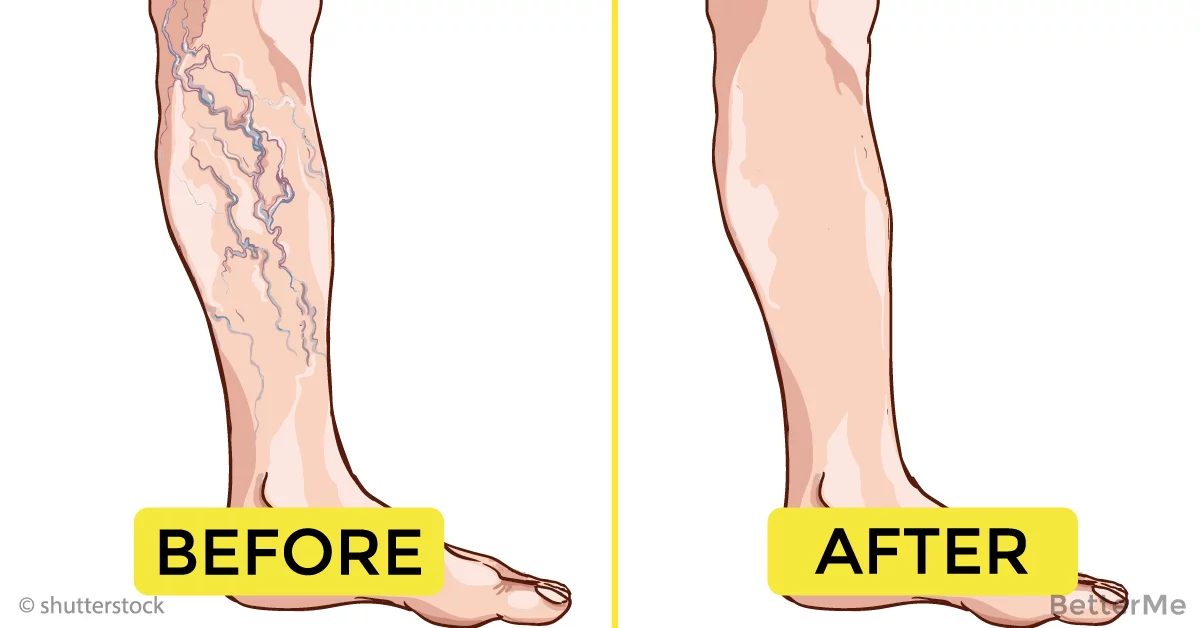 2 steps can help get rid of varicose veins naturally