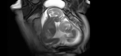 Twin Babies Caught On MRI Scan Fighting In Their Mother’s Womb! Amazing Video