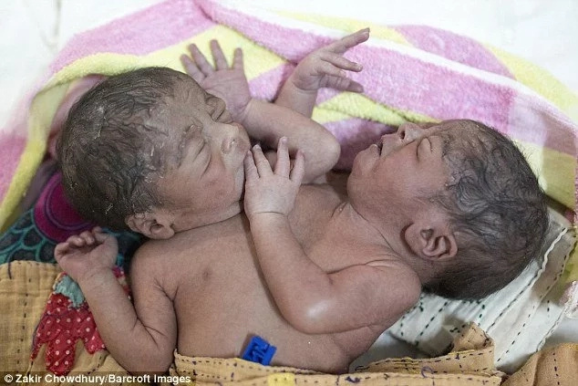 Conjoined Twins Born With Two Heads, Four Hands And Two Legs & Dumped By Parents (Photos) Conjoined Twins Born With Two Heads, Four Hands And Two Legs & Dumped By Parents (Photos)