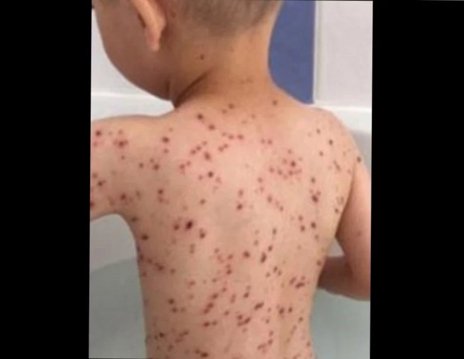 Horrifying Pictures Show Why You NEVER Give A Child Ibuprofen Horrifying Pictures Show Why You NEVER Give A Child Ibuprofen