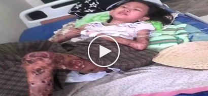 Heartbreaking video shows poor Iloilo girl with flesh-eating disease asking netizens for help