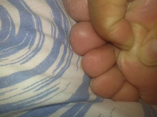 A strand of hair can cause pain on your feet! A strand of hair can cause pain on your feet!