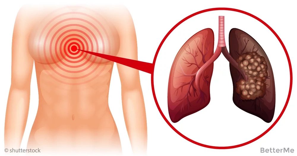 How to know when you have lung cancer