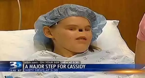 A girl was born without eyes nor nose. Doctors said they've never seen a case like this before! A girl was born without eyes nor nose. Doctors said they've never seen a case like this before!