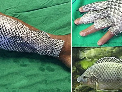 Fish Scales For Burnt Skin: News of This Revolutionary Treatment Is Taking Social Media By Storm