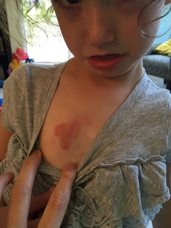 A girl ate mango sitting in the sun. Now her parents warn other people about this danger A girl ate mango sitting in the sun. Now her parents warn other people about this danger