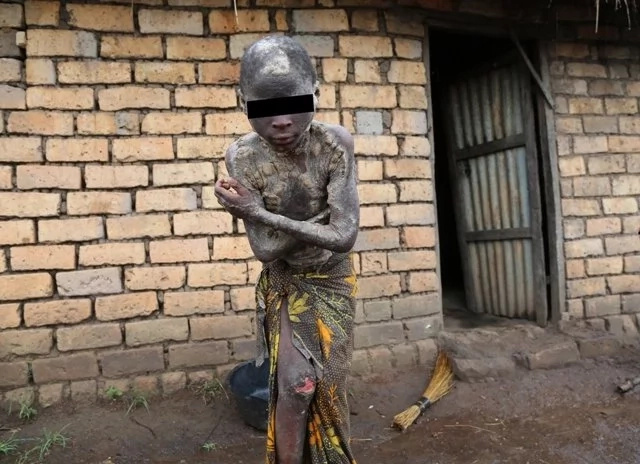 Boy, 13, suffers from strange skin disease that has left his family BANKRUPT and in deep agony (photos)