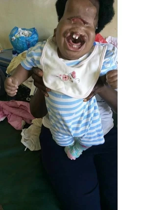 Child born with facial deformity abandoned in a Kisumu hospital (photos)