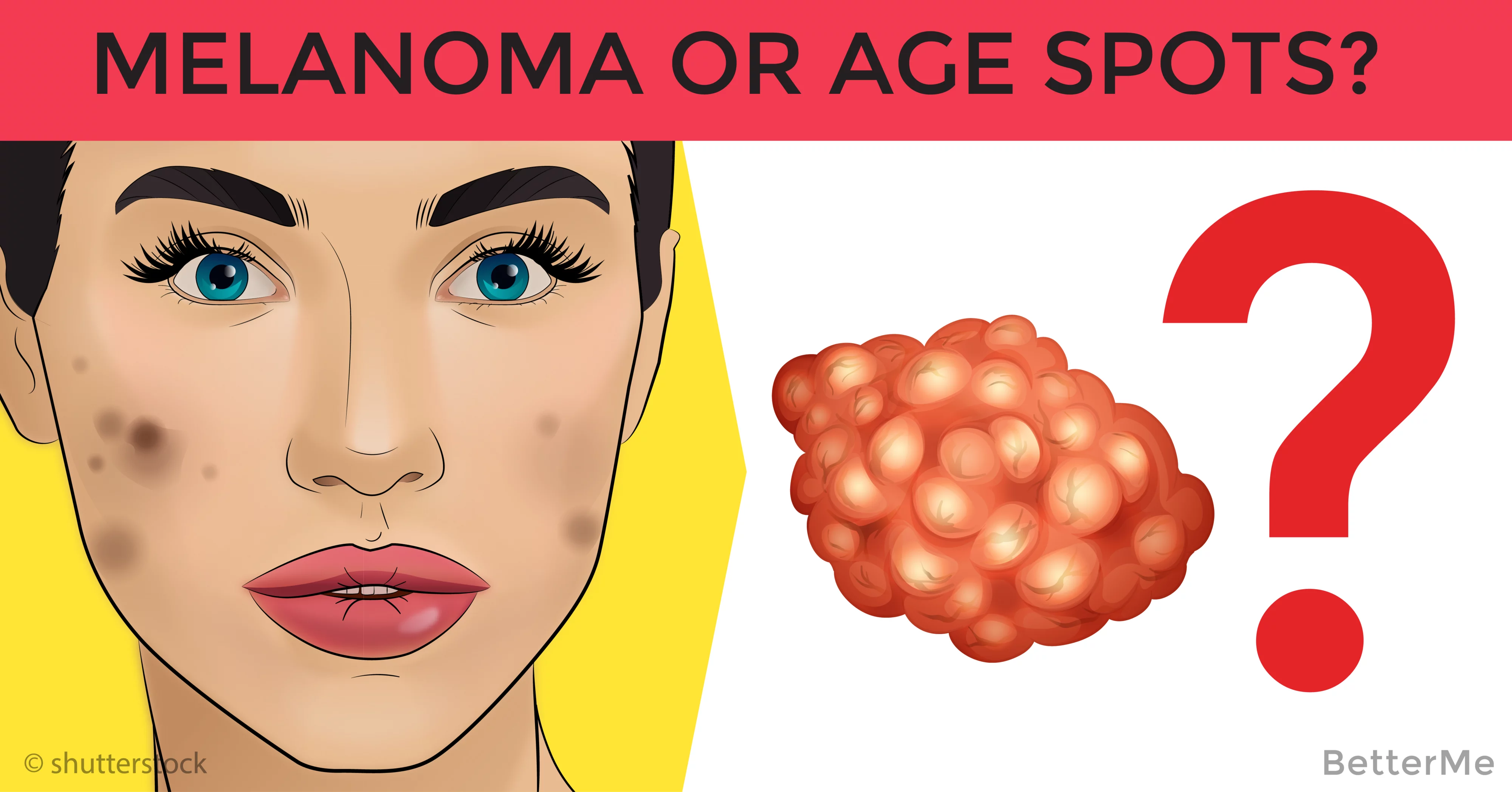 How To Tell The Difference Between Age Spots And Melanoma