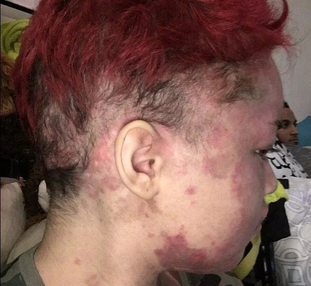 Woman’s Skin Burns From Inside Out Every Time She Goes Outside (Photos)