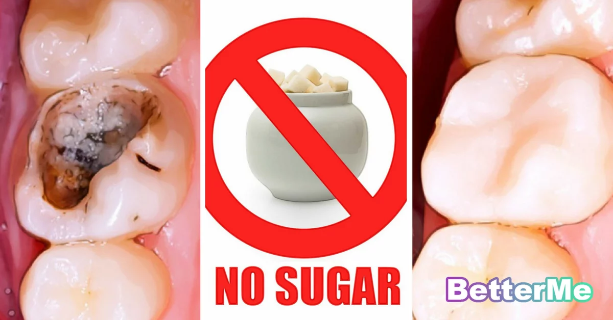 How To Heal Tooth Decay And Reverse Cavities